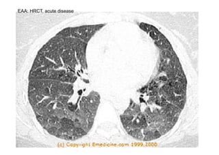 EAA: HRCT, acute disease
 
