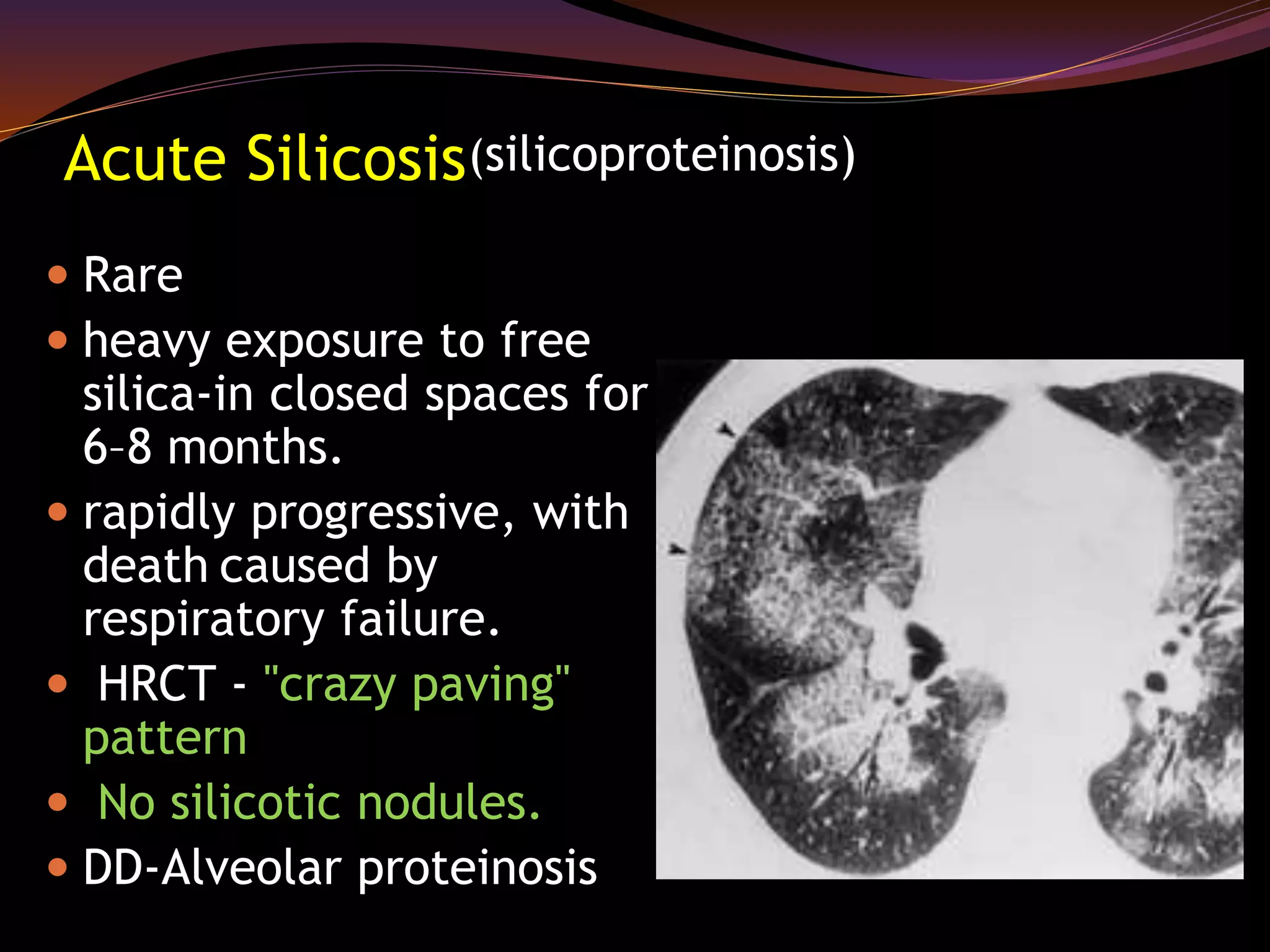 Acute Silicosis
 Rare
 heavy exposure to free
silica-in closed spaces for
6–8 months.
 rapidly progressive, with
death caused by
respiratory failure.
 HRCT - "crazy paving"
pattern
 No silicotic nodules.
 DD-Alveolar proteinosis
(silicoproteinosis)
 