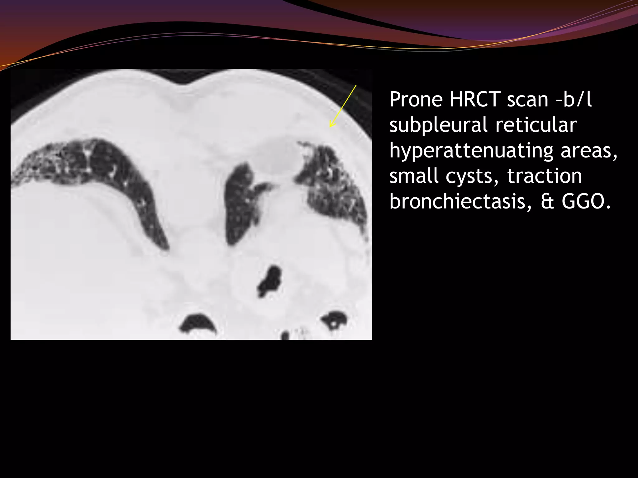 Prone HRCT scan –b/l
subpleural reticular
hyperattenuating areas,
small cysts, traction
bronchiectasis, & GGO.
 