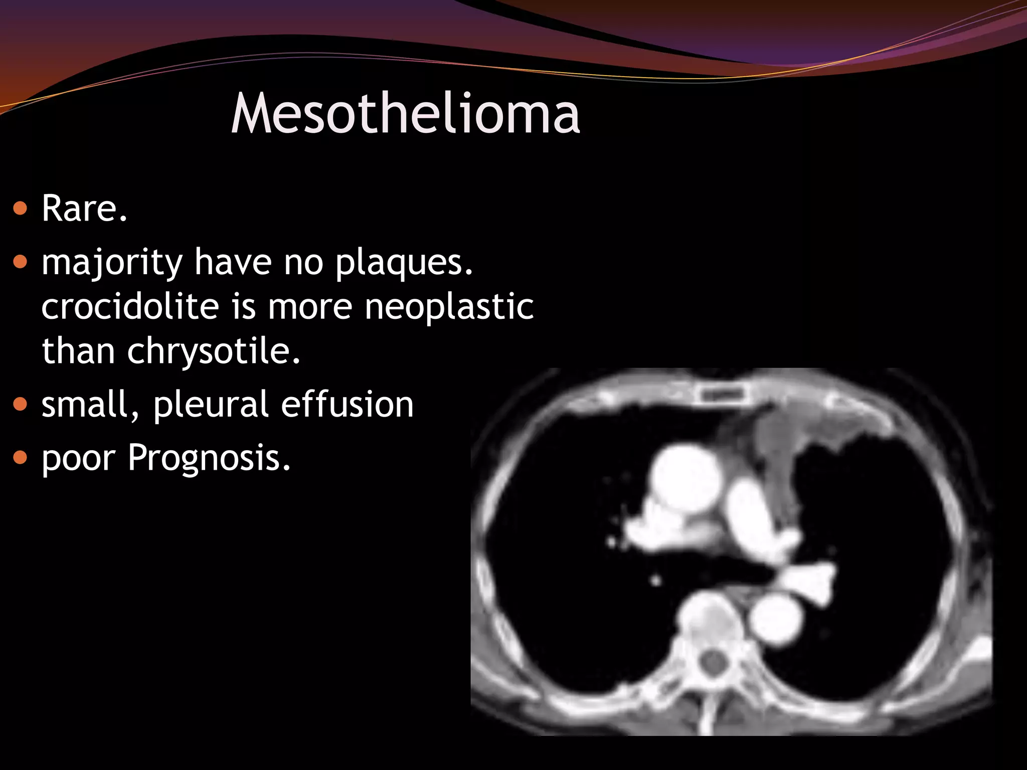 Mesothelioma
 Rare.
 majority have no plaques.
crocidolite is more neoplastic
than chrysotile.
 small, pleural effusion
 poor Prognosis.
 