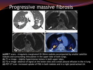 Occupational lung diseases radiology | PPTX