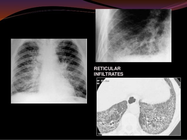 Occupational lung diseases radiology