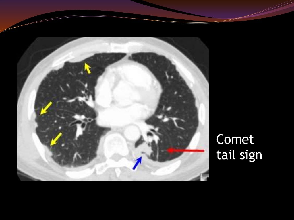 Occupational lung diseases radiology