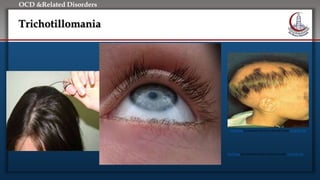 Click to edit Master title style
• Edit Master text styles
• Second level
• Third level
• Fourth level
• Fifth level
OCD &Related Disorders
Trichotillomania
This Photo by Unknown Author is licensed under CC BY-NC-ND
This Photo by Unknown Author is licensed under CC BY-NC-ND
 