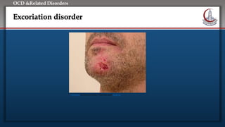 Click to edit Master title style
• Edit Master text styles
• Second level
• Third level
• Fourth level
• Fifth level
OCD &Related Disorders
Excoriation disorder
This Photo by Unknown Author is licensed under CC BY-SA
 