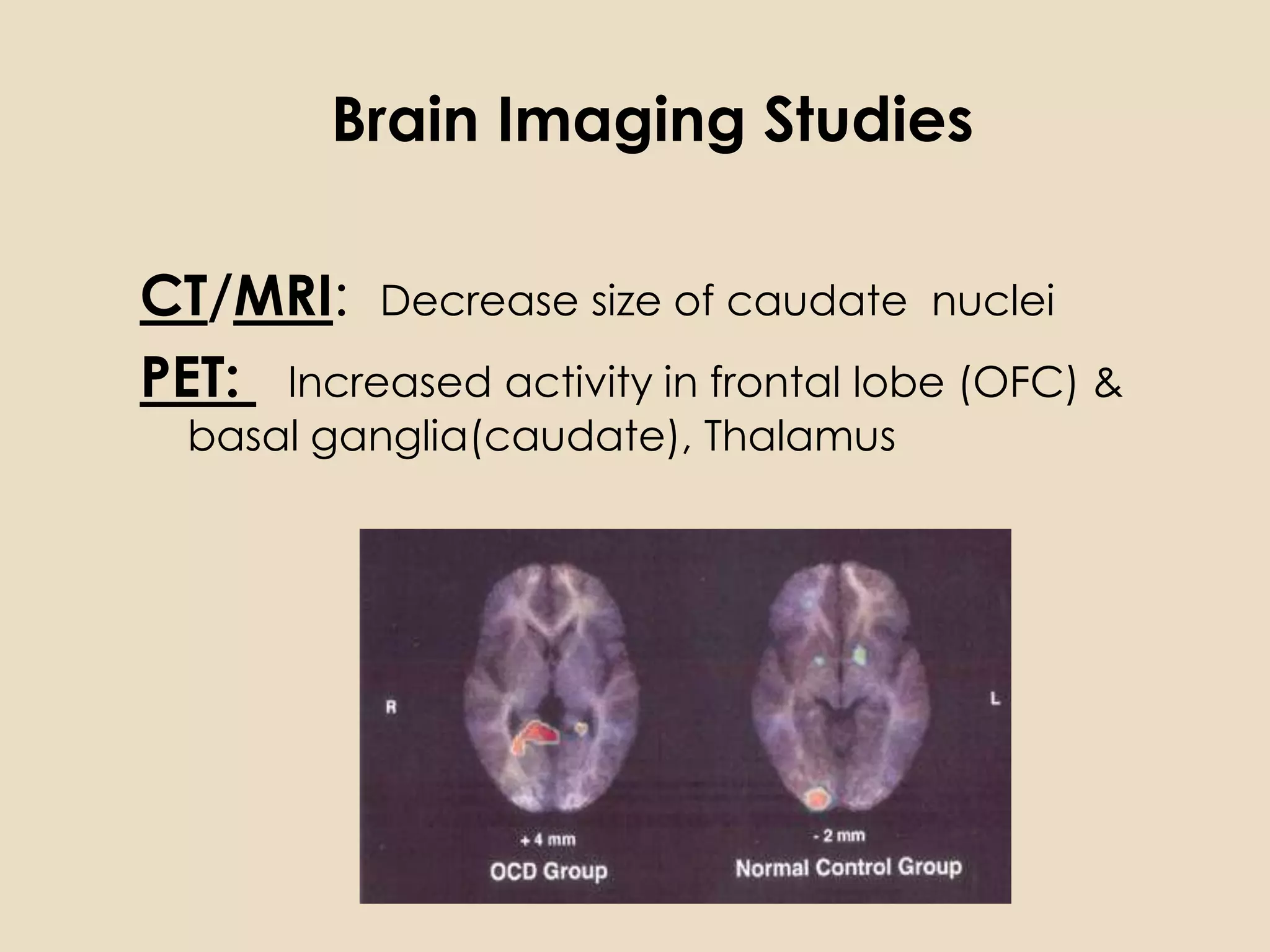 Brain Imaging Studies

CT/MRI: Decrease size of caudate nuclei
PET: Increased activity in frontal lobe (OFC) &
  basal ganglia(caudate), Thalamus
 