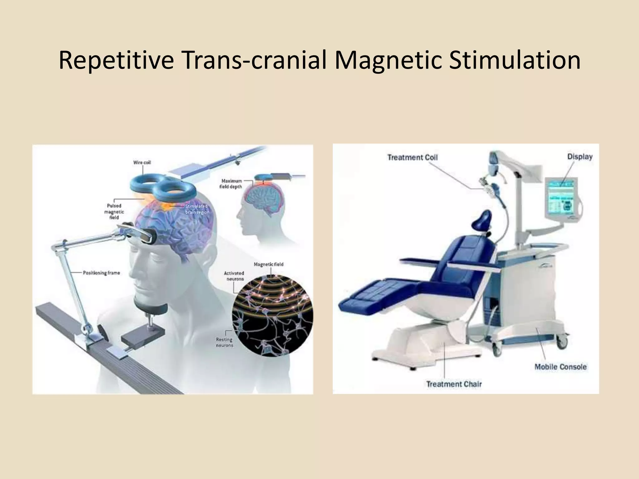 Repetitive Trans-cranial Magnetic Stimulation
 