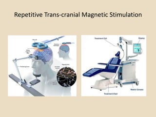 Repetitive Trans-cranial Magnetic Stimulation
 