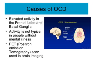 OBSESSIVE COMPULSIVE DISORDER (OCD) | PPT