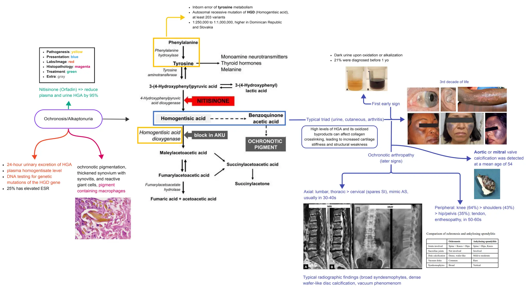 Ochronosis aka Alkaptonuria Important facts PPT