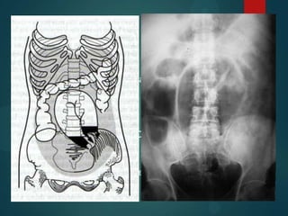 Estrangulación

  • Pocos niveles hidroaéreos

  • Puede haber ausencia de válvulas conniventes

  • En radiografías seriadas no cambia de localización

  • Imagen en grano de café: Obstrucción incompleta en asa
   cerrada


  • Neumoperitoneo          perforación
 