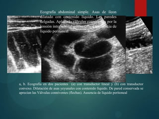 Ecografía abdominal simple. Asas de íleon
              dilatado con contenido líquido. Las paredes
              delgadas. Aplanado válvulas conniventes por la
              tensión intraluminal aumentada. La ausencia de
              líquido peritoneal




a, b. Ecografía en dos pacientes (a) con transductor lineal y (b) con transductor
convexo. Dilatación de asas yeyunales con contenido líquido. De pared conservada se
aprecian las Válvulas conniventes (flechas). Ausencia de líquido peritoneal
 