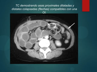 TC demostrando asas proximales dilatadas y
distales colapsadas (flechas) compatibles con una
                        OI.
 