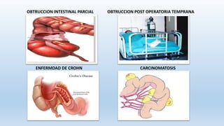 OBTRUCCION INTESTINAL PARCIAL OBTRUCCION POST OPERATORIA TEMPRANA
ENFERMDAD DE CROHN CARCINOMATOSIS
 