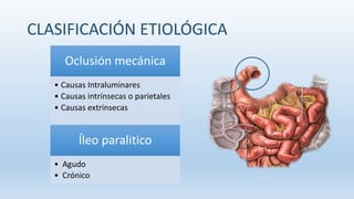 CLASIFICACIÓN ETIOLÓGICA
Oclusión mecánica
• Causas Intraluminares
• Causas intrínsecas o parietales
• Causas extrínsecas
Íleo paralitico
• Agudo
• Crónico
 