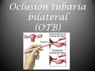 Oclusión tubaria bilateral (OTB) 
