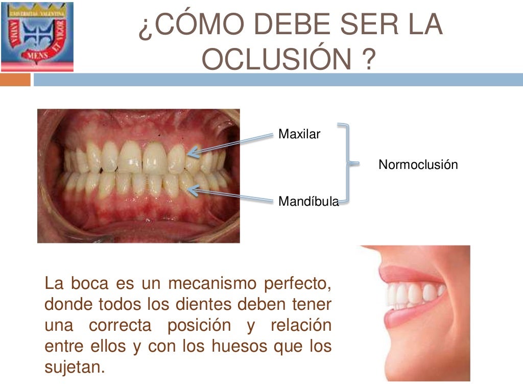 Oclusion Maloclusion