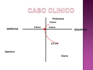Protrusiva
0.5mm

DERECHA

0.8mm

0.0mm

IZQUIERDA

2.5 cm

Apertura
Cierre

 
