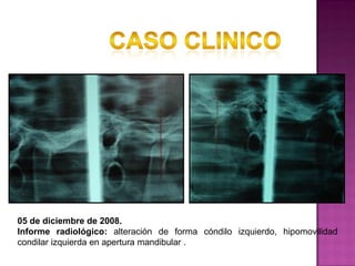 05 de diciembre de 2008.
Informe radiológico: alteración de forma cóndilo izquierdo, hipomovilidad
condilar izquierda en apertura mandibular .

 