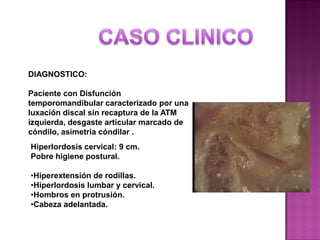 DIAGNOSTICO:
Paciente con Disfunción
temporomandibular caracterizado por una
luxación discal sin recaptura de la ATM
izquierda, desgaste articular marcado de
cóndilo, asimetria cóndilar .
Hiperlordosis cervical: 9 cm.
Pobre higiene postural.
•Hiperextensión de rodillas.
•Hiperlordosis lumbar y cervical.
•Hombros en protrusión.
•Cabeza adelantada.

 