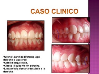 •Over jet canino: diferente lado
derecho e izquierdo.
•Clase II esqueletica.
•Classe III subdivisión derecha.
•Linea media dentaria desviada a la
derecha.

 
