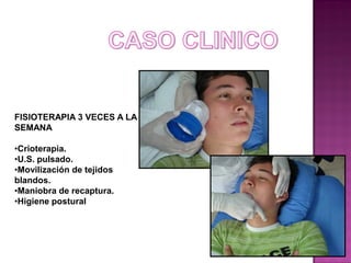 FISIOTERAPIA 3 VECES A LA
SEMANA
•Crioterapia.
•U.S. pulsado.
•Movilización de tejidos
blandos.
•Maniobra de recaptura.
•Higiene postural

 