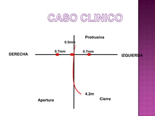 Protrusiva
0.5mm

0.7mm

DERECHA

0.7mm

IZQUIERDA

4.2m
Apertura

Cierre

 