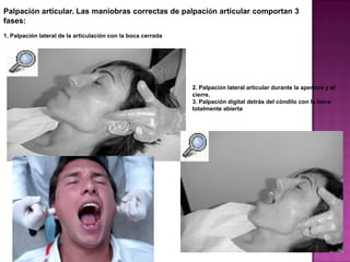 Palpación articular. Las maniobras correctas de palpación articular comportan 3
fases:
1. Palpación lateral de la articulación con la boca cerrada

2. Palpación lateral articular durante la apertura y el
cierre.
3. Palpación digital detrás del cóndilo con la boca
totalmente abierta

 