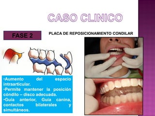 FASE 2

PLACA DE REPOSICIONAMIENTO CONDILAR

•Aumento
del
espacio
intraarticular.
•Permite mantener la posición
cóndilo – disco adecuada.
•Guía anterior, Guía canina,
contactos
bilaterales
y
simultáneos.

 