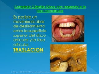  Es posible un
movimiento libre
de deslizamiento
entre la superficie
superior del disco
articular y la fosa
articular:
TRASLACION
C.D.RAUL MARTINEZ APARICIO-ramartinez60@hotmail.com
 