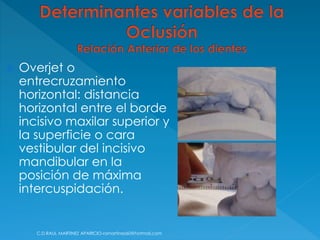  Overjet o
entrecruzamiento
horizontal: distancia
horizontal entre el borde
incisivo maxilar superior y
la superficie o cara
vestibular del incisivo
mandibular en la
posición de máxima
intercuspidación.
C.D.RAUL MARTINEZ APARICIO-ramartinez60@hotmail.com
 