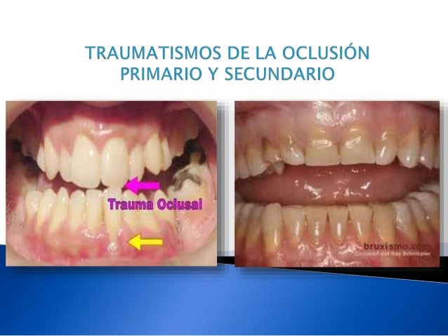 Oclusion best