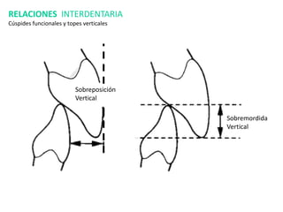 RELACIONES INTERDENTARIA
Cúspides funcionales y topes verticales
Sobreposición
Vertical
Sobremordida
Vertical
 