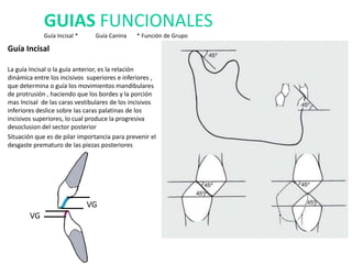 Guía Incisal
La guía Incisal o la guía anterior, es la relación
dinámica entre los incisivos superiores e inferiores ,
que determina o guía los movimientos mandibulares
de protrusión , haciendo que los bordes y la porción
mas Incisal de las caras vestibulares de los incisivos
inferiores deslice sobre las caras palatinas de los
incisivos superiores, lo cual produce la progresiva
desoclusion del sector posterior
Situación que es de pilar importancia para prevenir el
desgaste prematuro de las piezas posteriores
GUIAS FUNCIONALES
Guía Incisal * Guía Canina * Función de Grupo
VG
VG
 