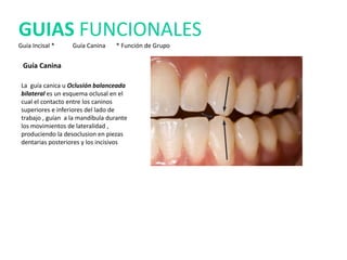 Guía Canina
La guía canica u Oclusión balanceada
bilateral es un esquema oclusal en el
cual el contacto entre los caninos
superiores e inferiores del lado de
trabajo , guían a la mandíbula durante
los movimientos de lateralidad ,
produciendo la desoclusion en piezas
dentarias posteriores y los incisivos
GUIAS FUNCIONALES
Guía Incisal * Guía Canina * Función de Grupo
 