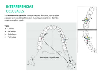 Las interferencias oclusales son contactos no deseados , que pueden
producir la desviación del recorrido mandibular durante los distintos
movimientos funcionales
Tipos
 Céntrica
 De Trabajo
 De Balance
 Protrusiva
INTERFERENCIAS
OCLUSALES
 