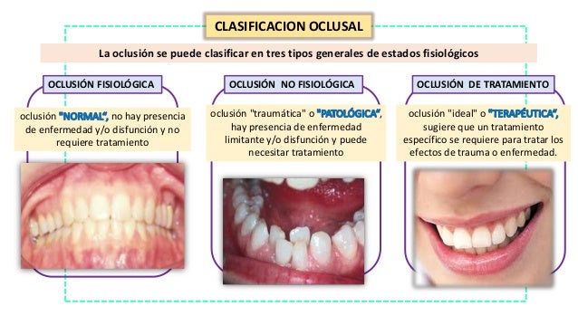 Oclusion dental alineacion y oclusion de los dientes