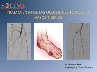 TRATAMIENTO DE LAS OCLUSIONES TOTALES EN
VASOS TIBIALES
Dr. Gerardo Peón
Angiología y Cirugía Vascular
 