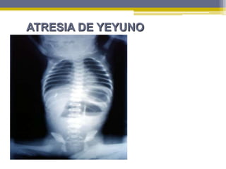 ATRESIA DE YEYUNO
 