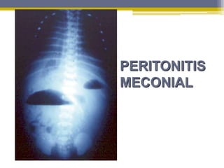 PERITONITIS
MECONIAL
 