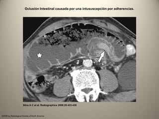 Oclusión intestinal | PPT