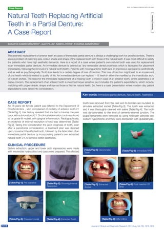 Journal of Clinical and Diagnostic Research. 2013 Aug, Vol-7(8): 1818-181918181818
Case Report DOI: 10.7860/JCDR/2013/5774.3291
Natural Teeth Replacing Artificial
Teeth in a Partial Denture:
A Case Report
Key words: Immediate partial denture, Natural teeth, Aesthetics
Case report
An 18-years old female patient was referred to the Department of
Prosthodontics , who complained of mobility of anterior tooth-21
[Table/Fig-1]. Her history revealed that she had a trauma one year
back,withsub-luxationof21.Onclinicalexamination,toothwasfound
to be grade III mobile, with gingival inflammation. Radiographically,
an evidence of internal resorption of root was determined [Table/
Fig-2]. Taking into consideration the poor prognosis of tooth, even
after a periodontal consideration, a treatment plan was decided
upon, to extract the affected tooth, followed by the fabrication of an
immediate partial denture by incorporating patient’s own extracted
natural tooth-21, to achieve better aesthetics.
Clinical procedure
Before extraction, upper and lower arch impressions were made
with irreversible hydrocolloid and casts were prepared. The affected DentistrySection
Sukanta Kumar Satapathy1
, Ajay Pillai2
, Ramya Jyothi3
, P. Durga Annapurna4
[Table/Fig-3]: Prepared model
[Table/Fig-1]: Pre operative [Table/Fig-2]: Showing Internal
Resorption
[Table/Fig-4]: Extracted Tooth
[Table/Fig-5]: Decoronated
Tooth
[Table/Fig-6]: Immediate RPD
ABSTRACT
The aesthetic replacement of anterior teeth in cases of immediate partial denture is always a challenging work for prosthodontists. There is
always problem of matching size, colour, shade and shape of the replaced tooth with those of the natural teeth. It was most difficult to satisfy
the patients who have high aesthetic demands. Here is a report of a case where patient’s own natural tooth was used for replacement
in an immediate partial denture. An immediate denture is defined as “any removable dental prosthesis which is fabricated for placement
immediately, following the removal of a natural tooth/teeth”. Patients with missing anterior teeth lack an impressive appearance aesthet­ically
and as well as psychologically. Tooth loss leads to a certain degree of loss of function. This loss of function might lead to an impairment
of oral health which is related to quality of life. An immediate denture can replace 1-16 teeth in either the maxillary or the mandibular arch,
or in both arches. The need for the immediate replacement of a missing tooth is more in case of an anterior tooth, where aesthetics is of
prime concern. The replacement of an anterior tooth is most technique sensitive, as it includes the patient’s expectations, which include,
matching with proper shade, shape and size as those of his/her natural teeth. So, here is a case presentation where modern day patient
expectations were taken into consideration.
[Table/Fig-7]: Extracted
Socket
[Table/Fig-8]: Post Insertion Of
RPD
tooth was removed from the cast and its borders are rounded, to
simulate extracted socket [Table/Fig-3]. The tooth was extracted
and it was thoroughly cleaned with saline [Table/Fig-4]. The tooth
was de-coronated to the level of cemento-enamel junction. The
pulpal remanents were removed by using hydrogen peroxide and
sodium hypochlorite and they were disinfected with glutaldehyde..
[Table/Fig-9]: After 24hrs
 
