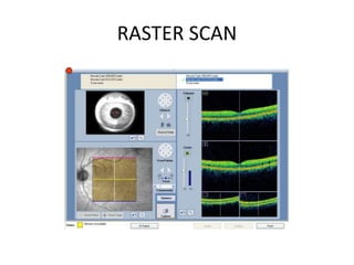 Oct Raster Scan Optical coherence tomography | PPTX