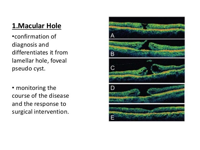 guide to optical coherence tomography interpretation