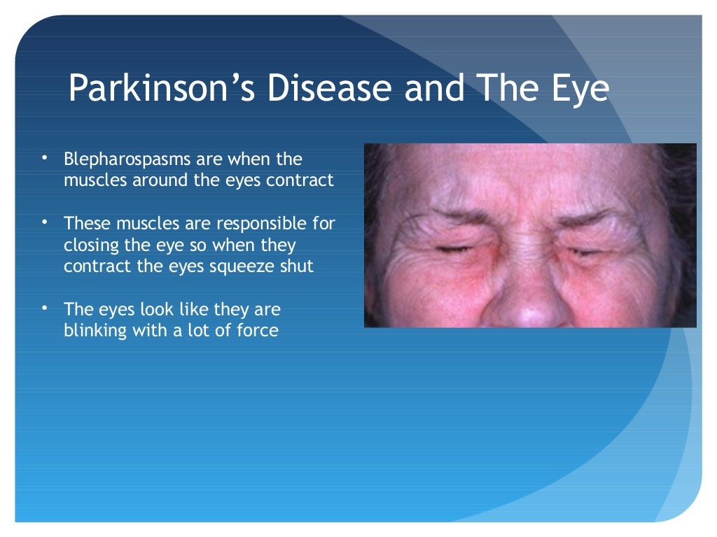 Parkinson's Disease and the Eye