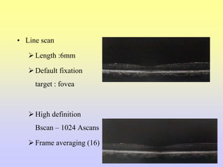 • Line scan
Length :6mm
Default fixation
target : fovea
High definition
Bscan – 1024 Ascans
Frame averaging (16)
 