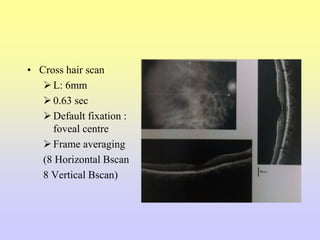 • Cross hair scan
L: 6mm
0.63 sec
Default fixation :
foveal centre
Frame averaging
(8 Horizontal Bscan
8 Vertical Bscan)
 