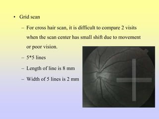 • Grid scan
– For cross hair scan, it is difficult to compare 2 visits
when the scan center has small shift due to movement
or poor vision.
– 5*5 lines
– Length of line is 8 mm
– Width of 5 lines is 2 mm
 