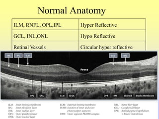 Normal Anatomy
ILM, RNFL, OPL,IPL Hyper Reflective
GCL, INL,ONL Hypo Reflective
Retinal Vessels Circular hyper reflective
 