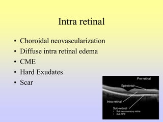 Intra retinal
• Choroidal neovascularization
• Diffuse intra retinal edema
• CME
• Hard Exudates
• Scar
 